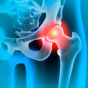 Arthroplasty and sports medicine